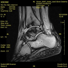 Oscan Ankle Xbone T1